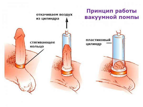 Возбужденный член в помпе